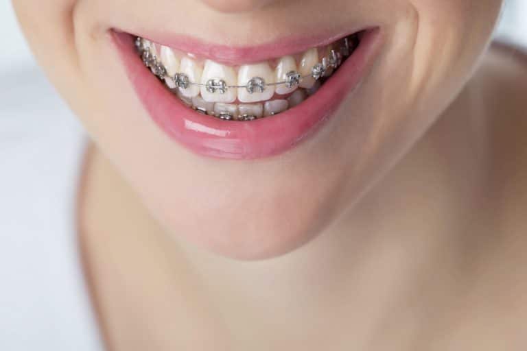 Orthodontic Care Tips Keeping Your Braces Safe! Springfield, OH