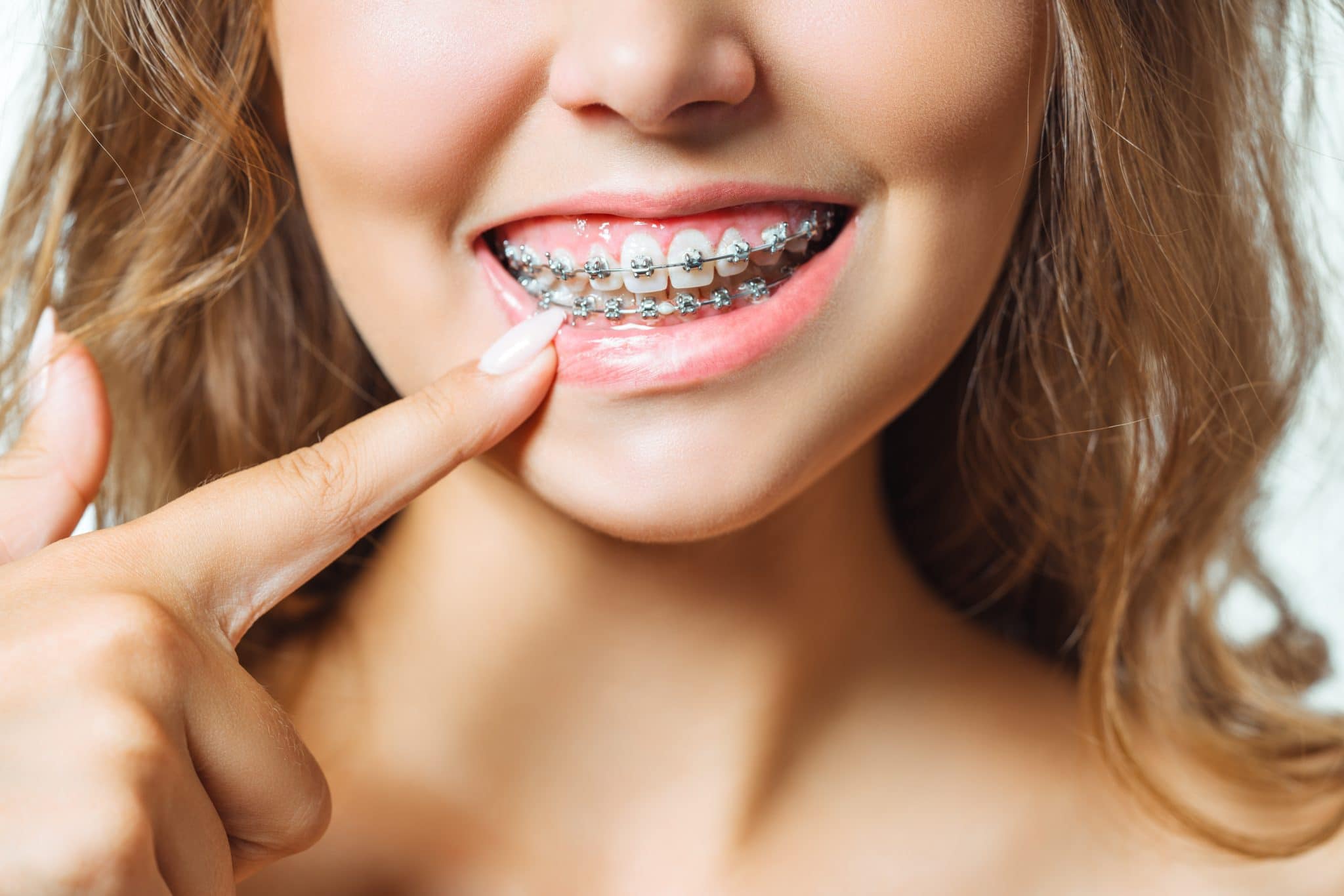 understanding-the-parts-and-function-of-braces-springfield-oh