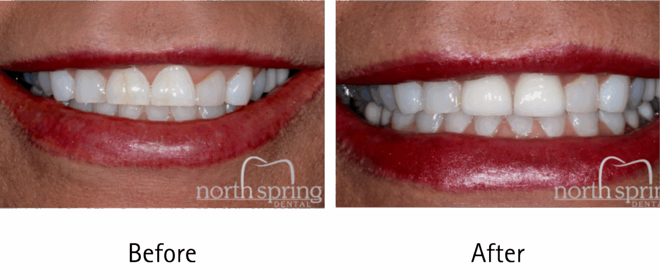 cosmetic dentistry before and after in Springfield, OH